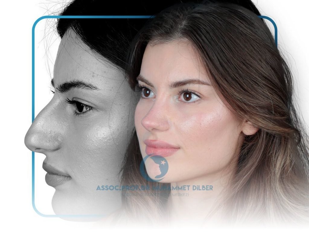 best rhinoplasty turkey - nose job in istanbul