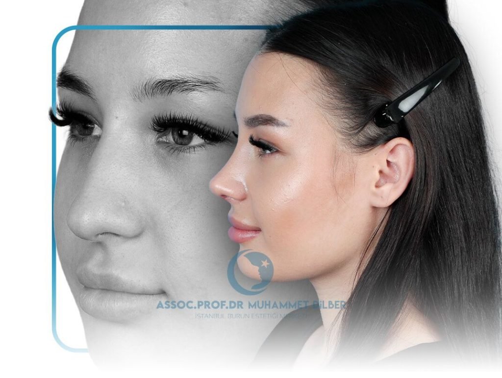 ultrasonic rhinoplasty turkey before after - what is ultrasonic rhinoplasty