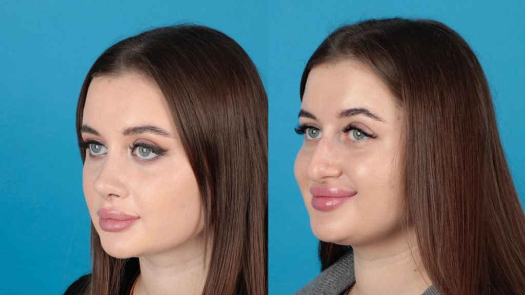 rhinoplasty turkey before after - natural results