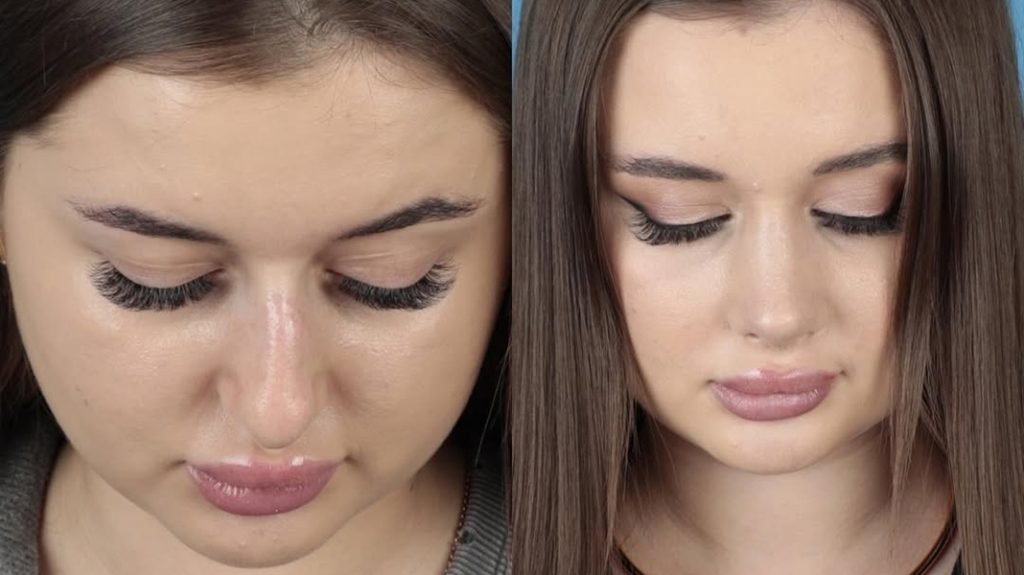 rhinoplasty istanbul before after - natural results