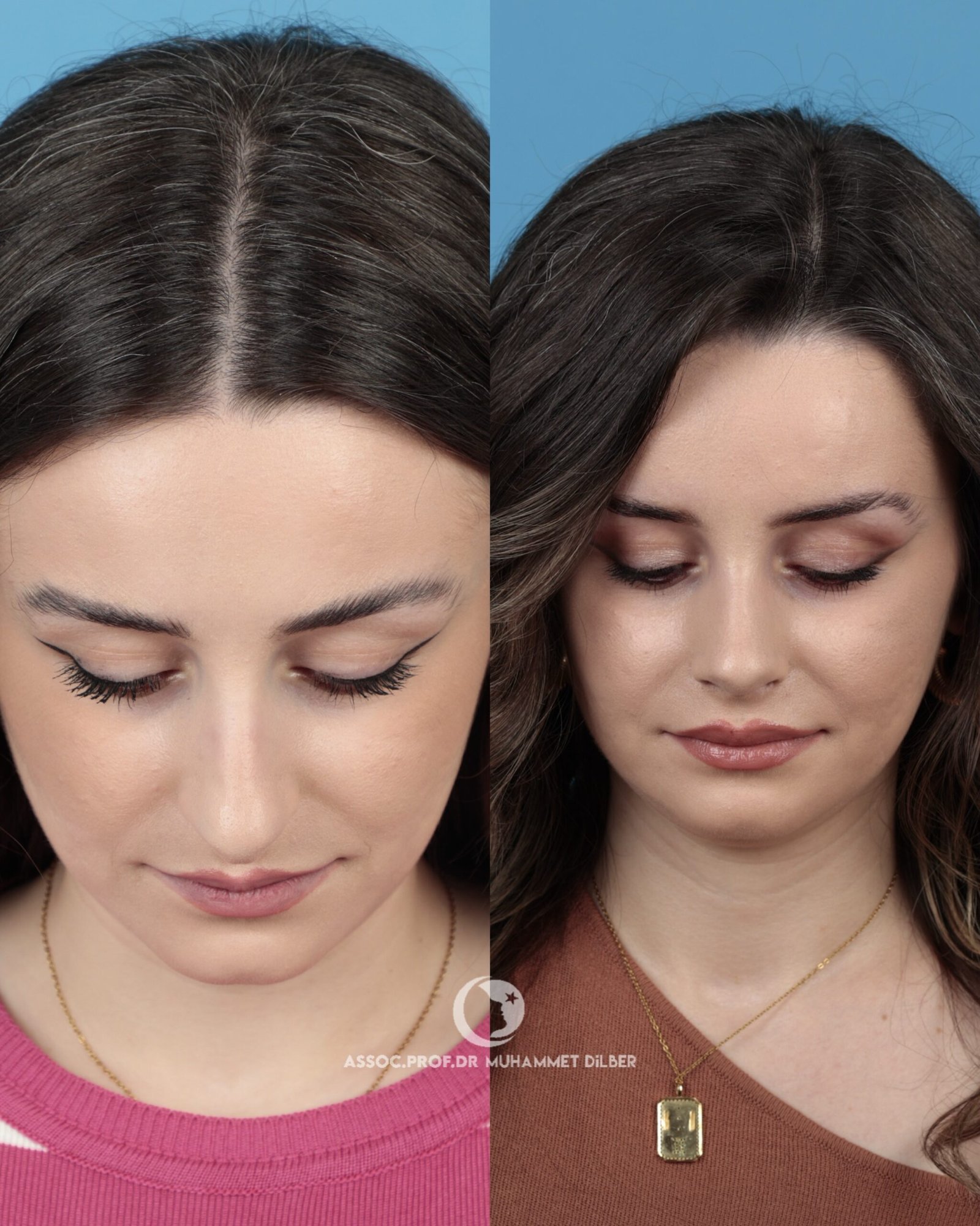 Nostril correction before after