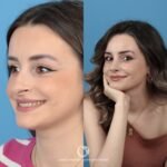 Why Are My Nostrils So Visible