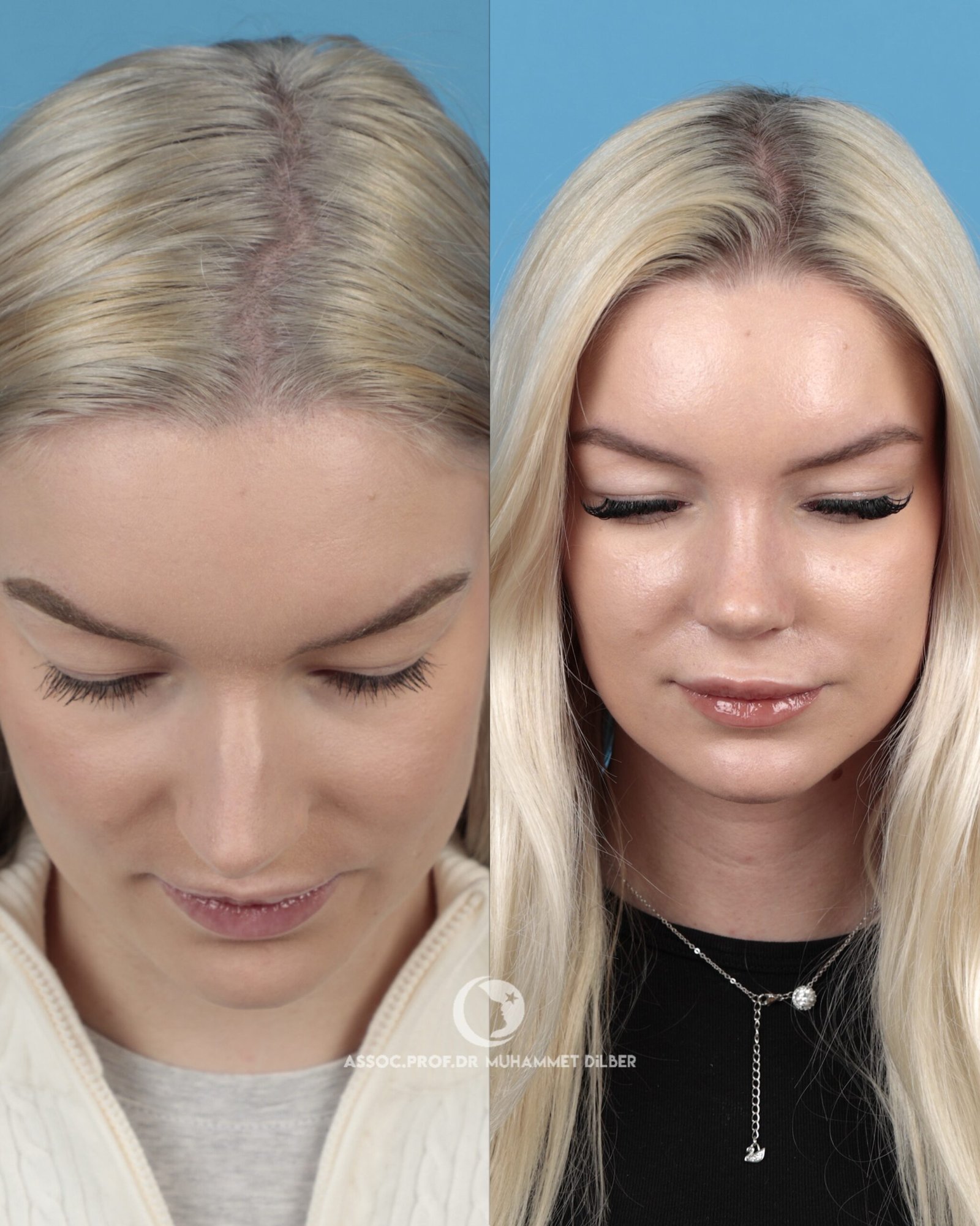 get long nose bridge naturally