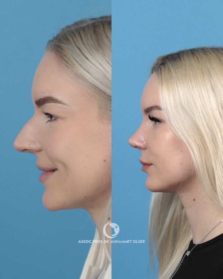 long nose bridge rhinoplasty before after