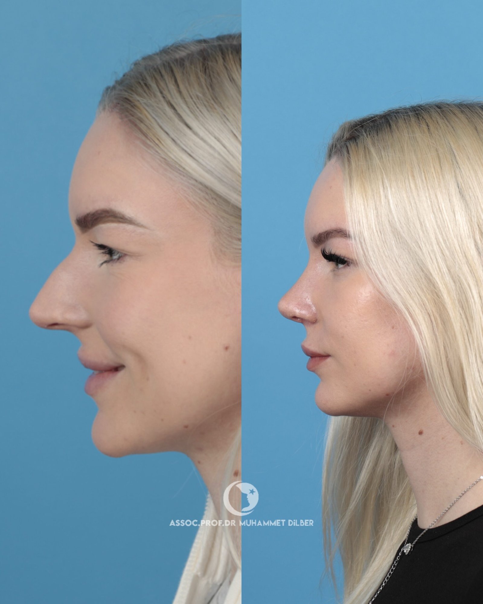 long nose bridge rhinoplasty before after