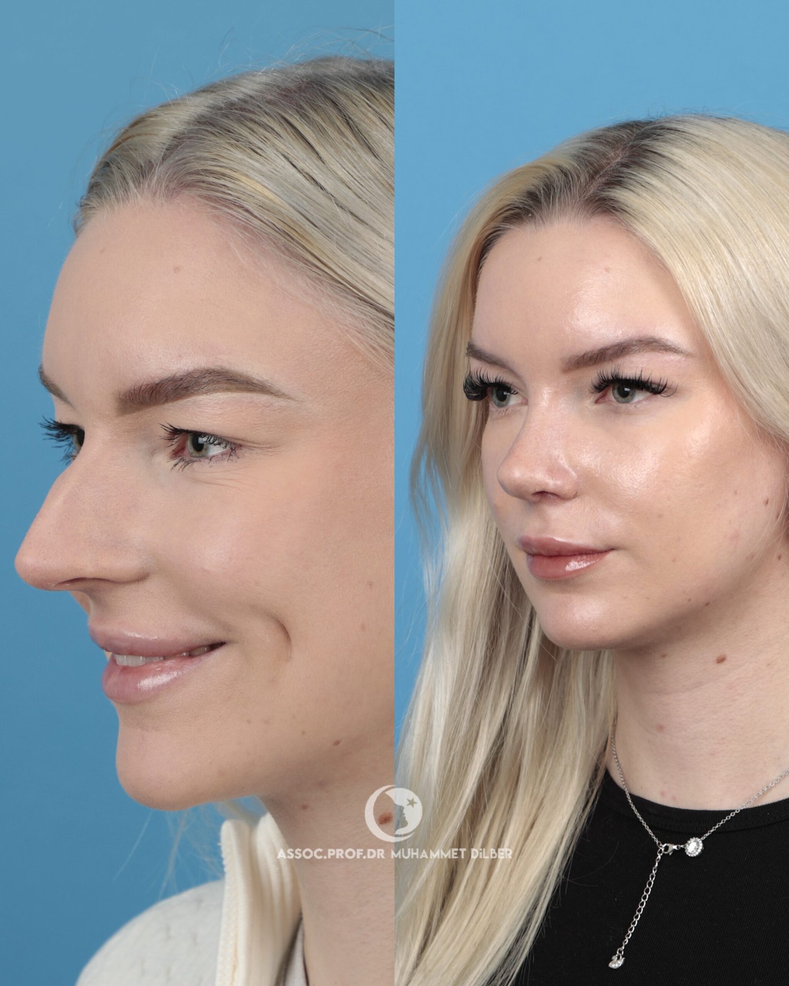 long nose bridge surgery before after