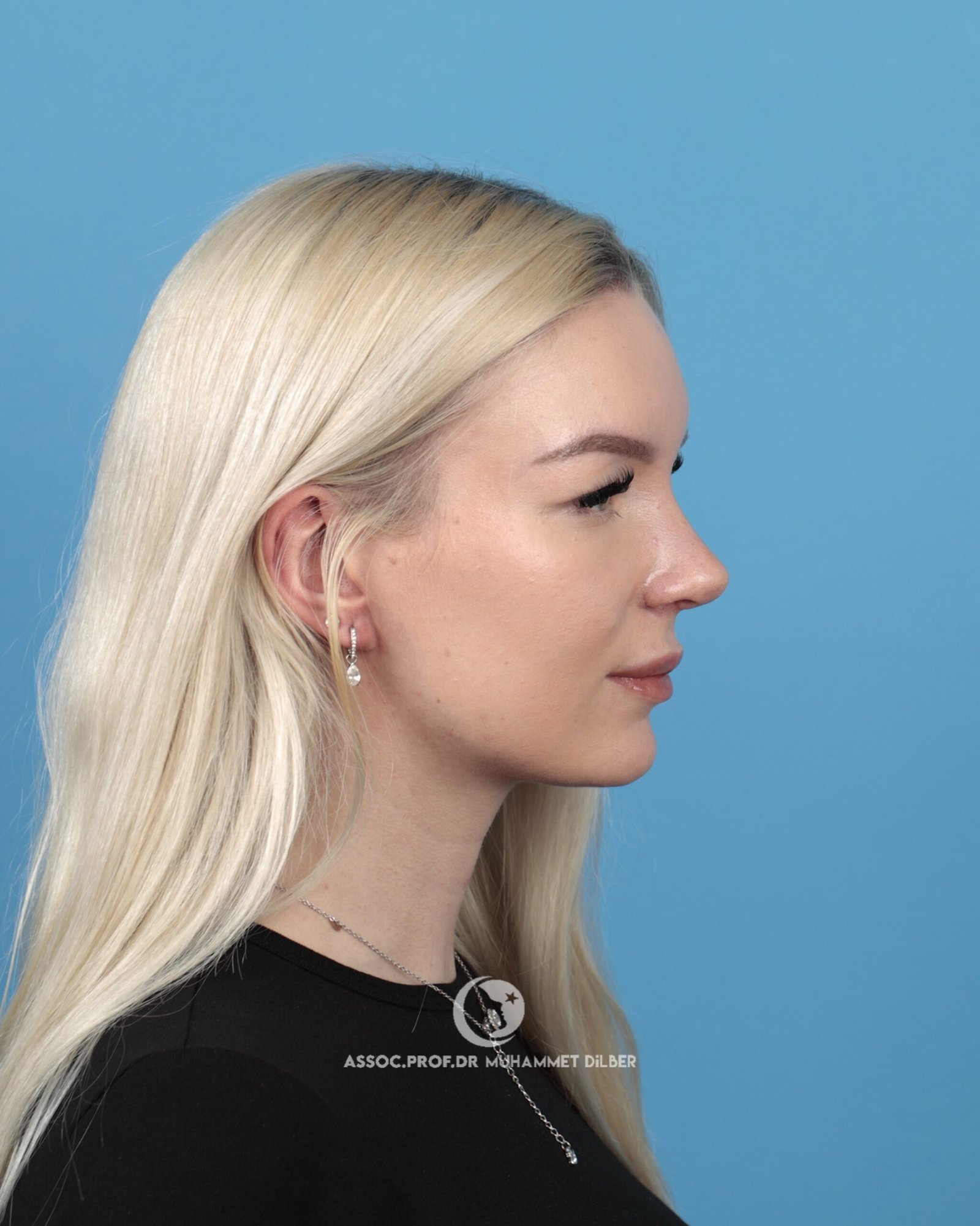 reduce nose bridge istanbul