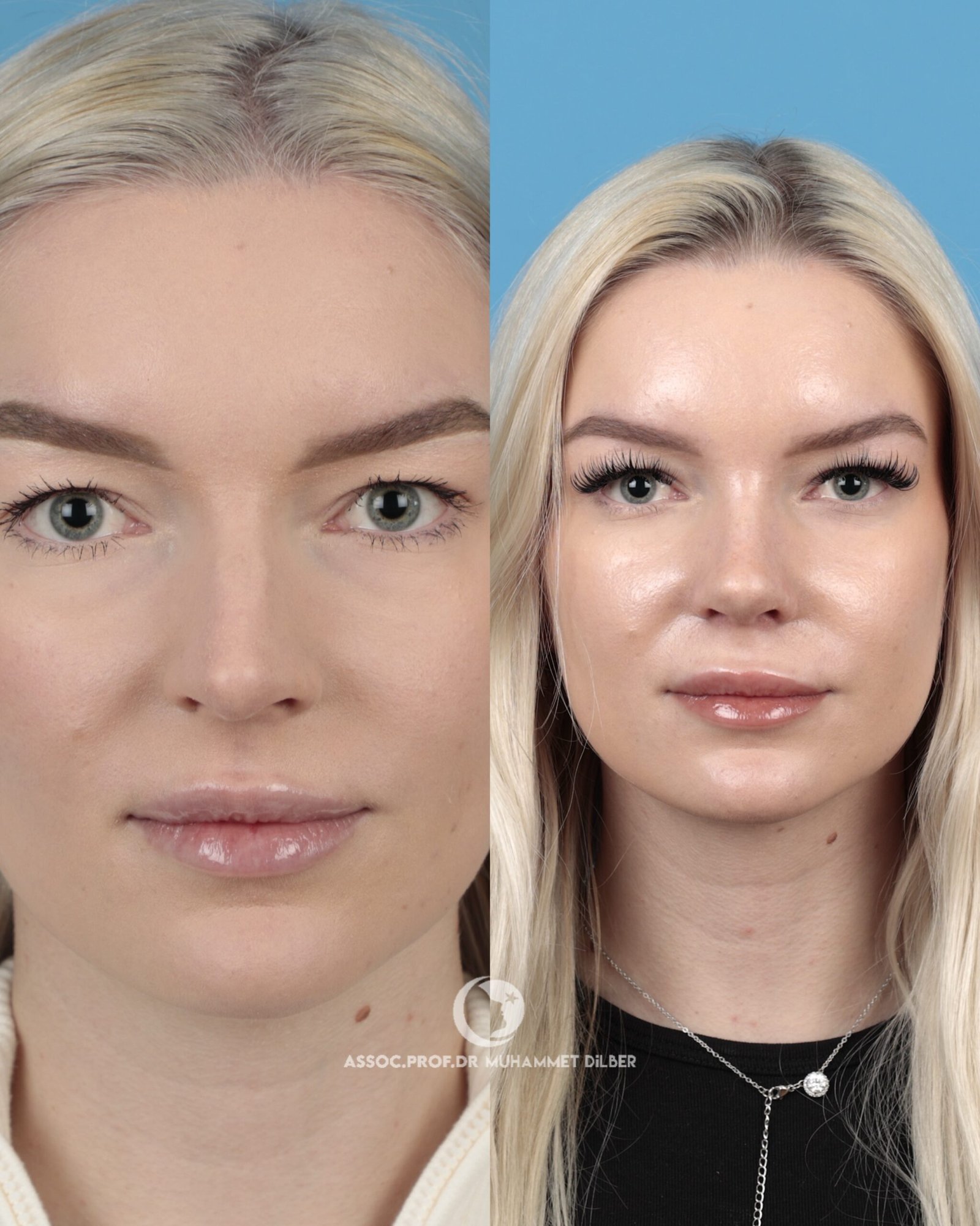 reduce nose bridge naturally