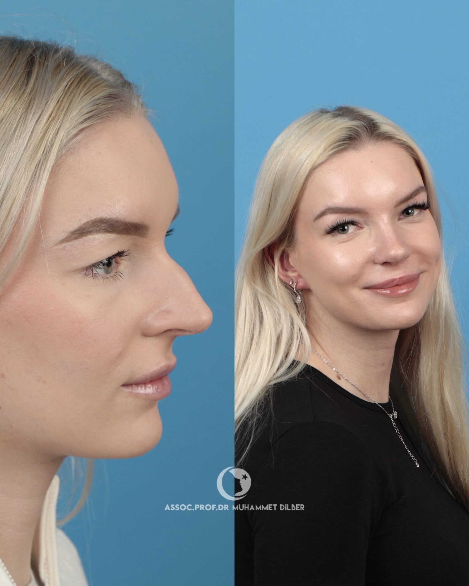 reduce nose bridge turkey