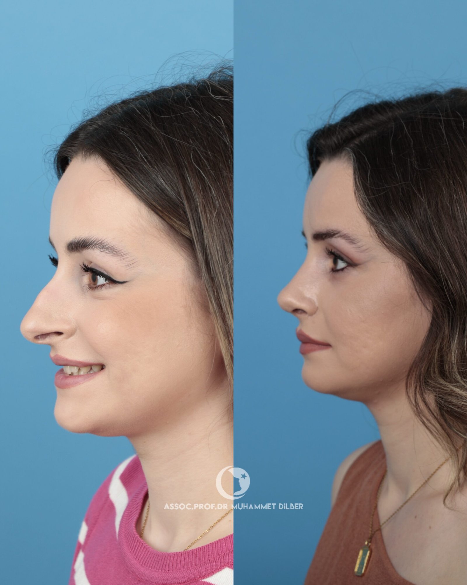 visible nostrils surgery istanbul