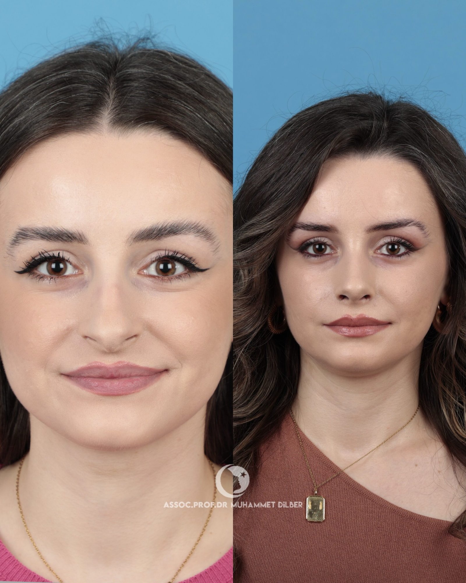 visible nostrils surgery