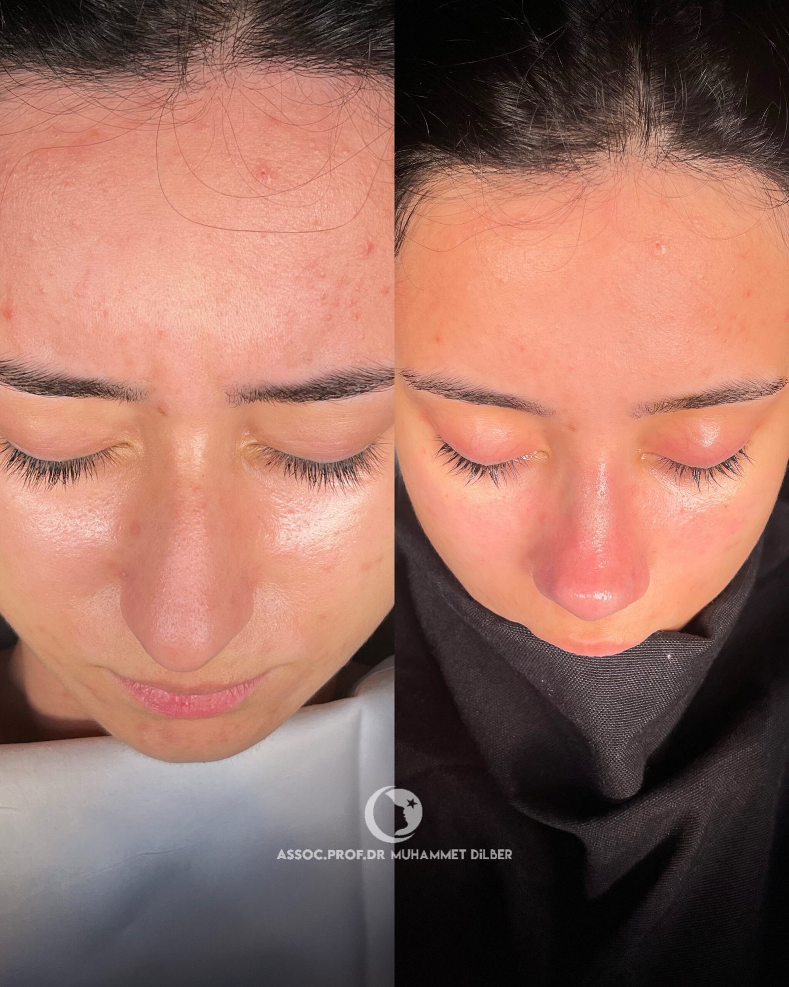 Arched nose, big nose before after