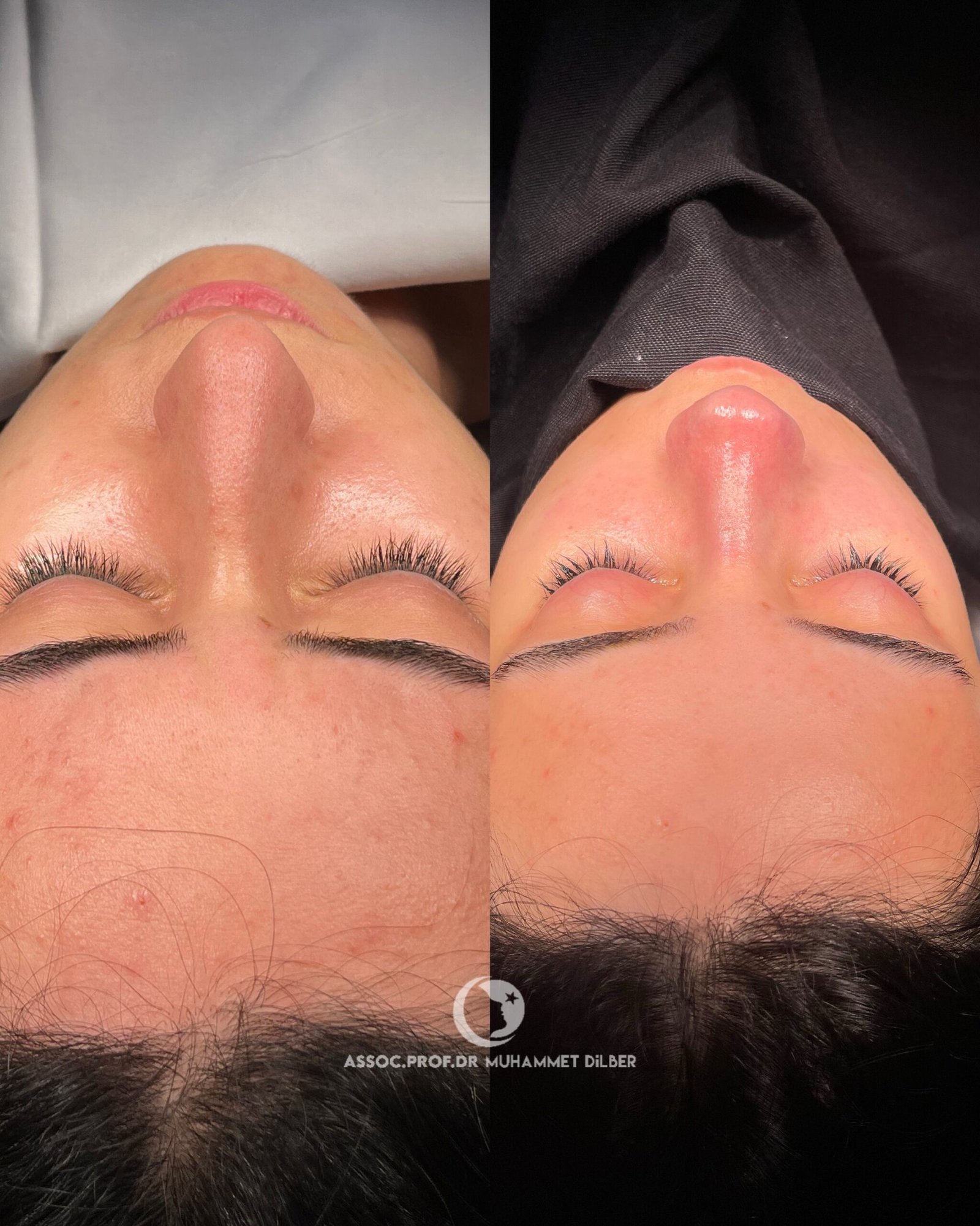 Arched nose surgery before after