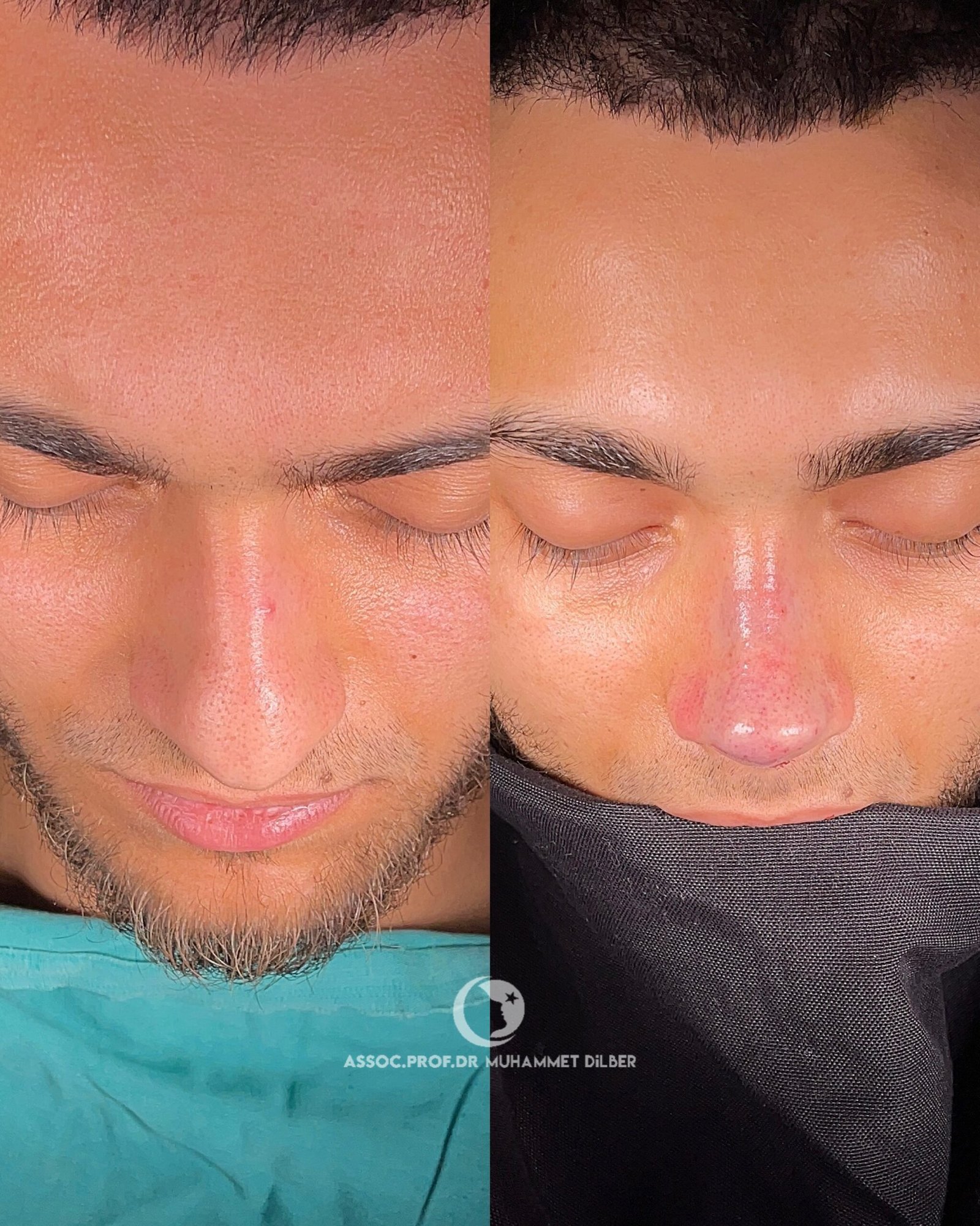 Can Rhinoplasty Really Fix Breathing Problems