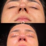 arched nose surgery turkey