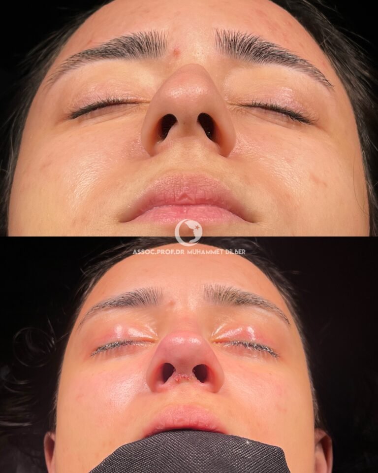 arched nose surgery turkey