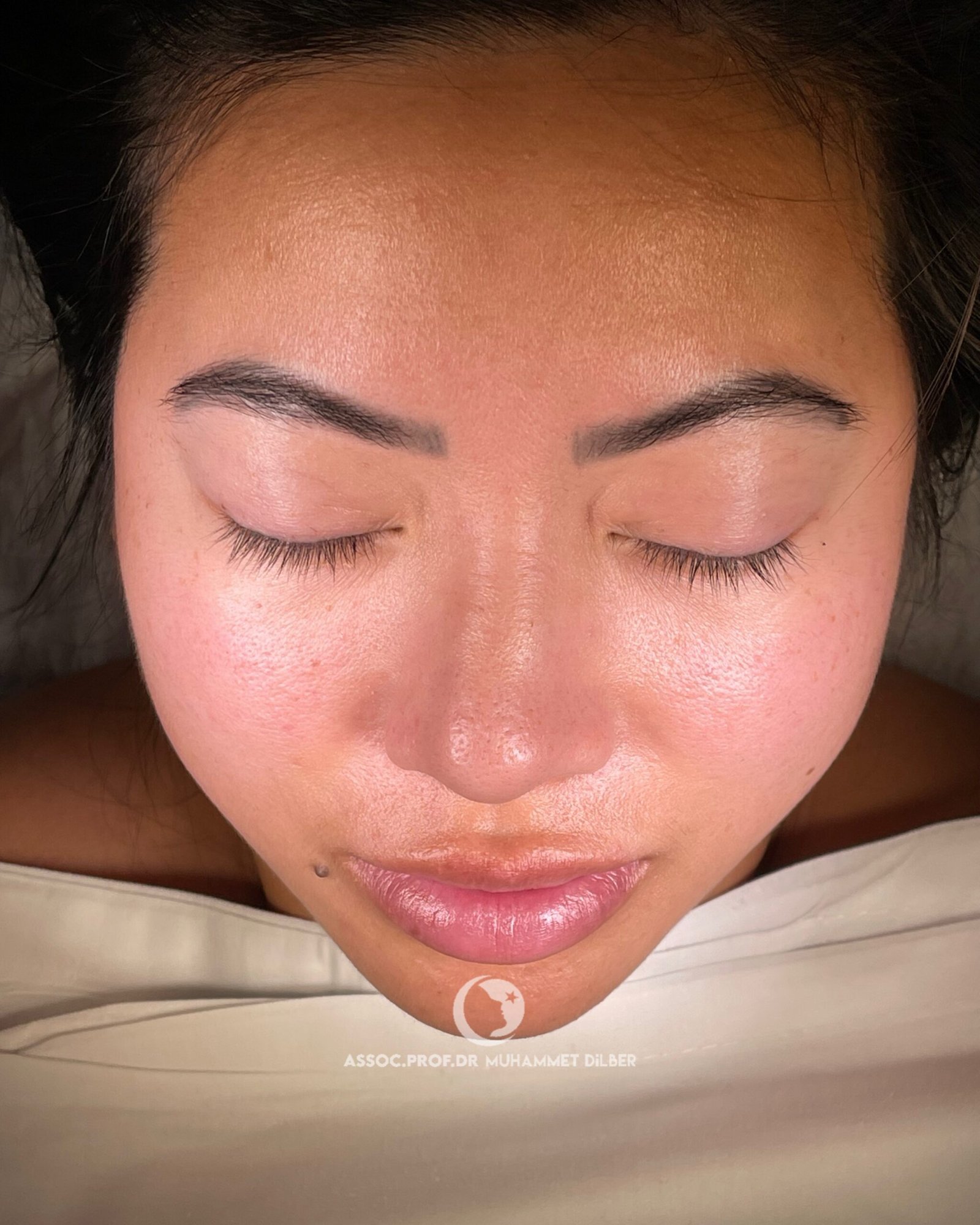 asian ethnic rhinoplasty istanbul