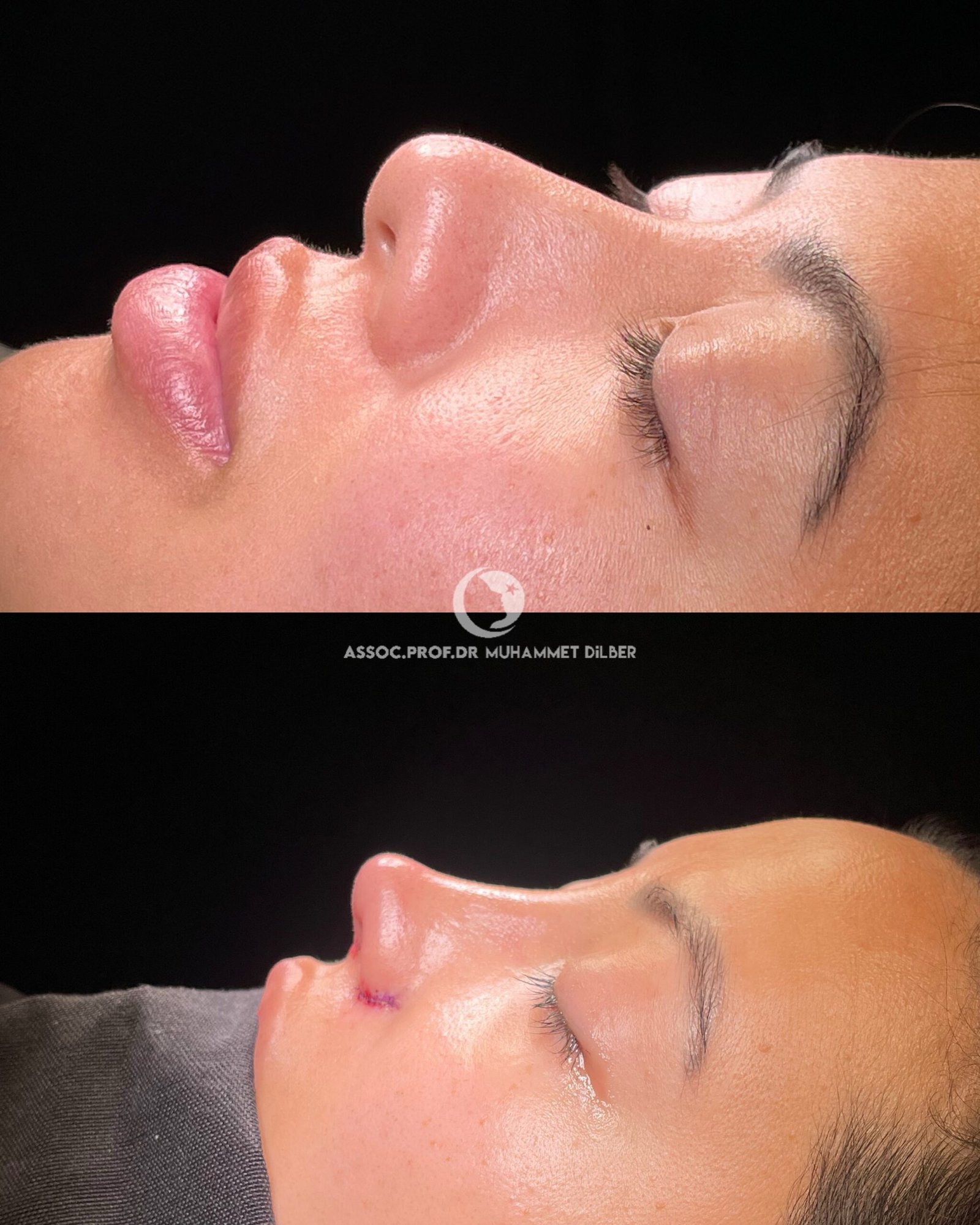 asian ethnic rhinoplasty turkey