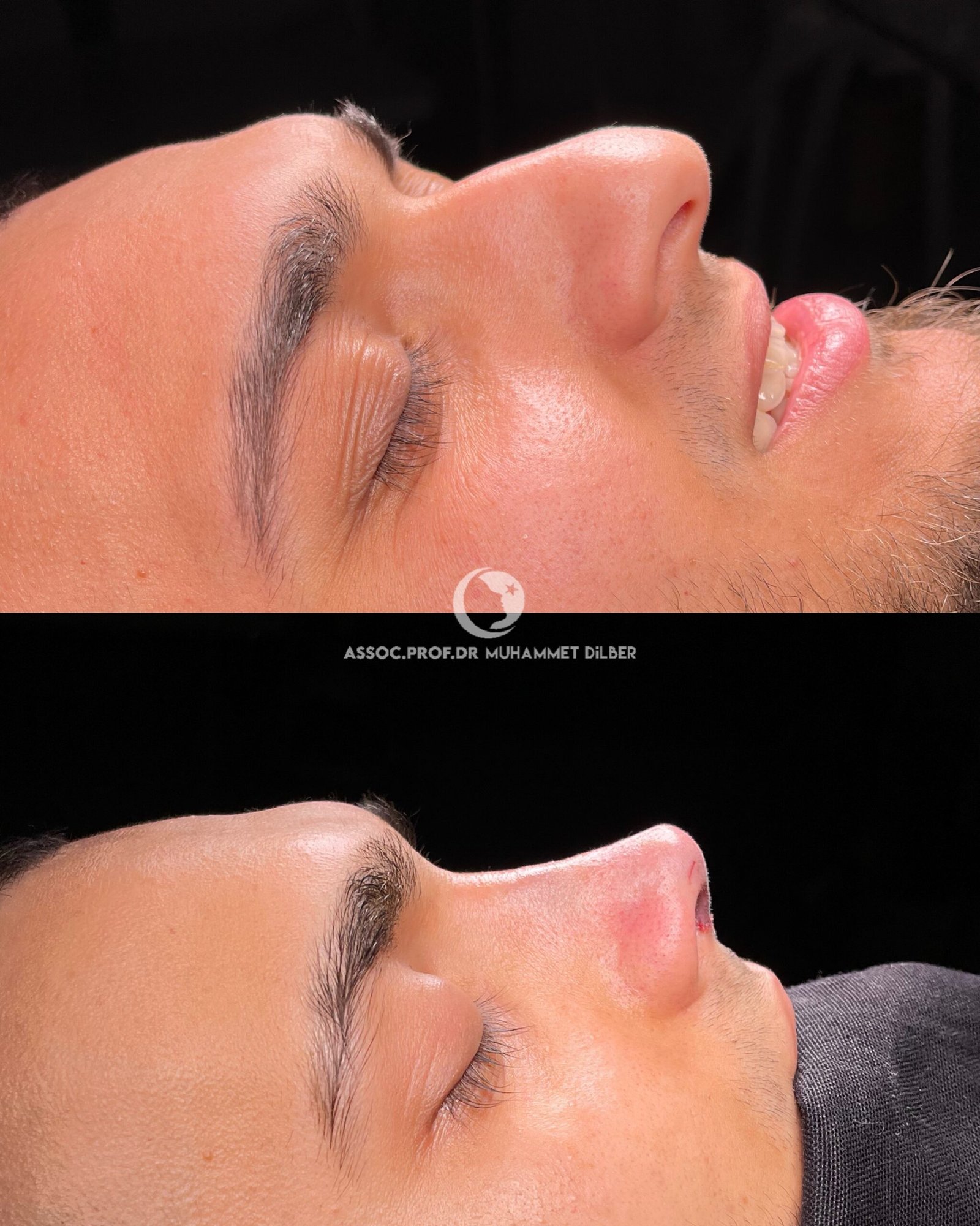 before after enlarged turbinates - droopy nose tip