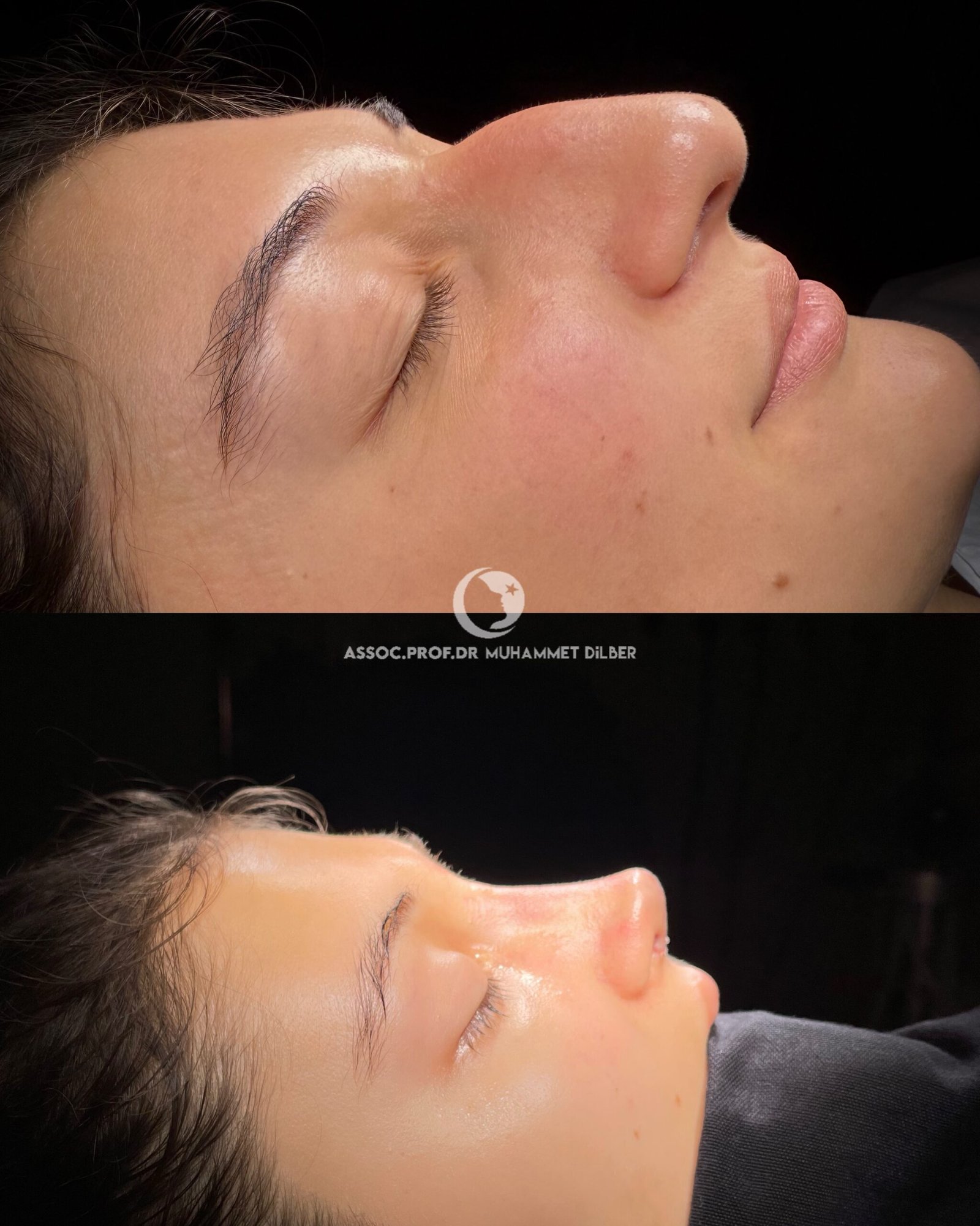 big humpy nose before after