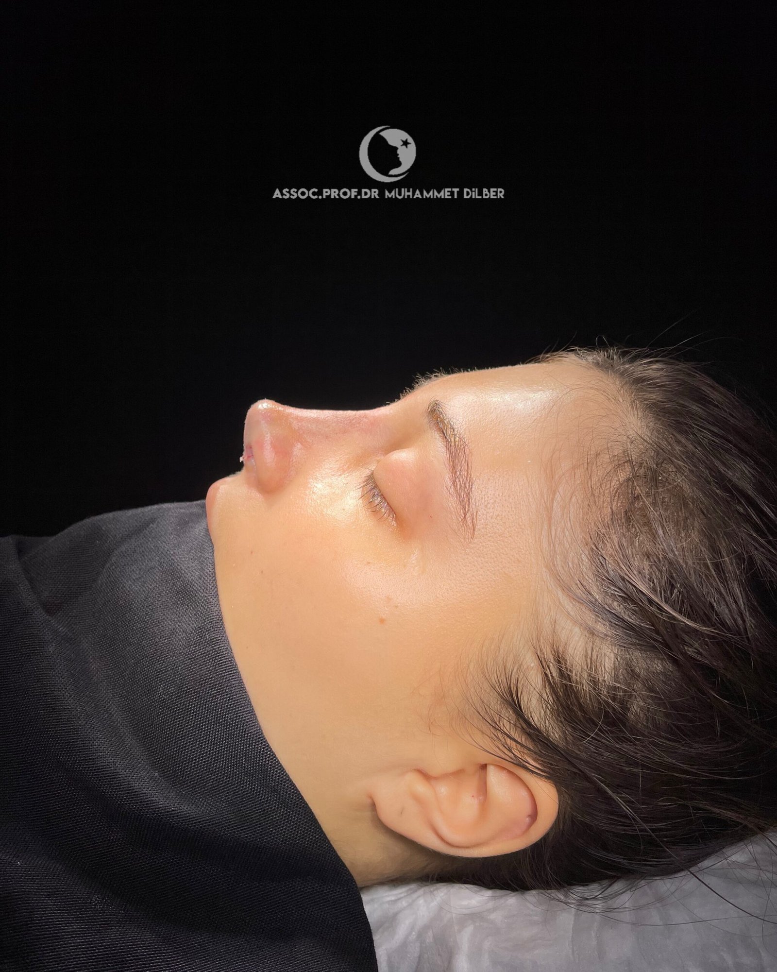 big humpy nose result