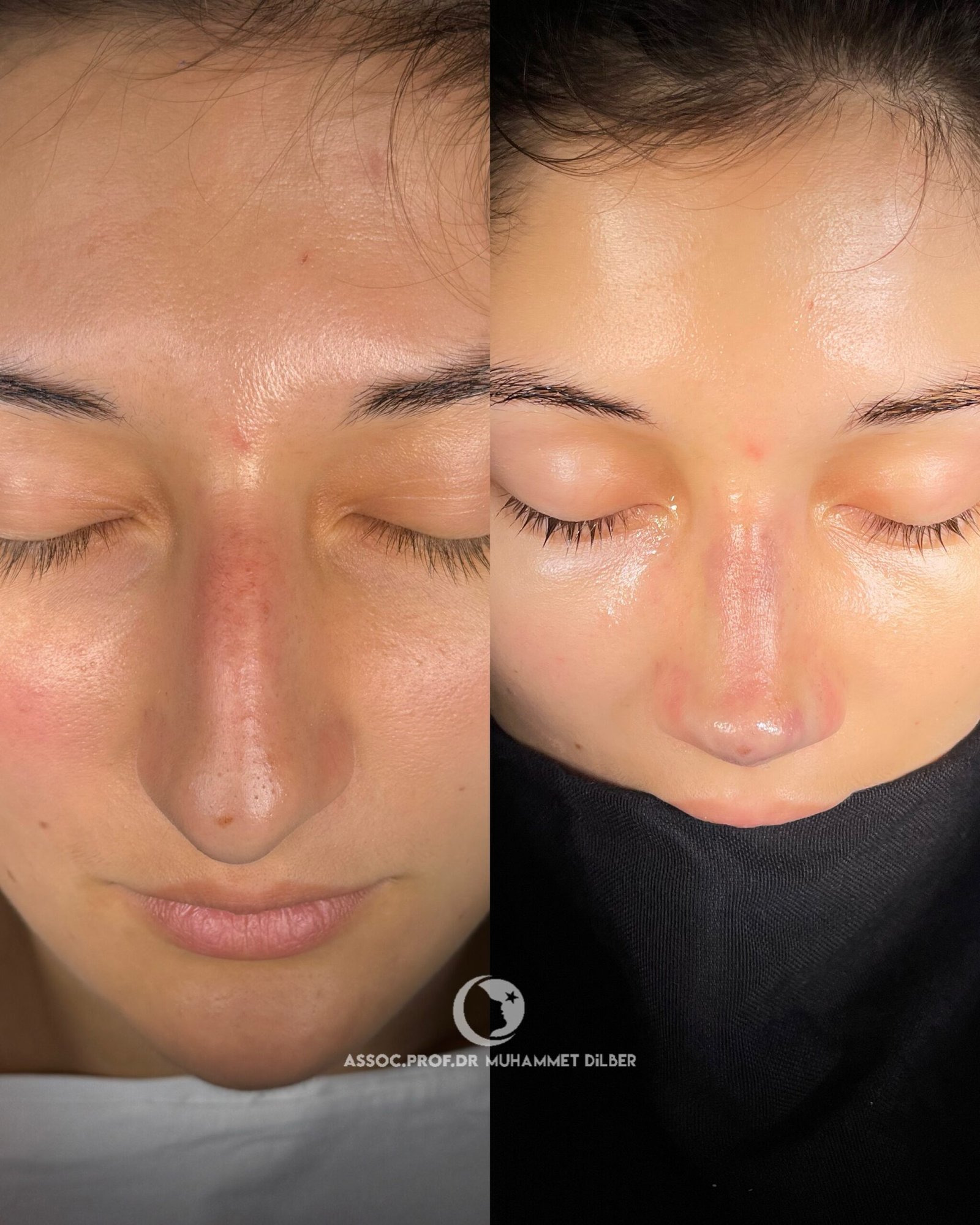 big humpy nose surgery