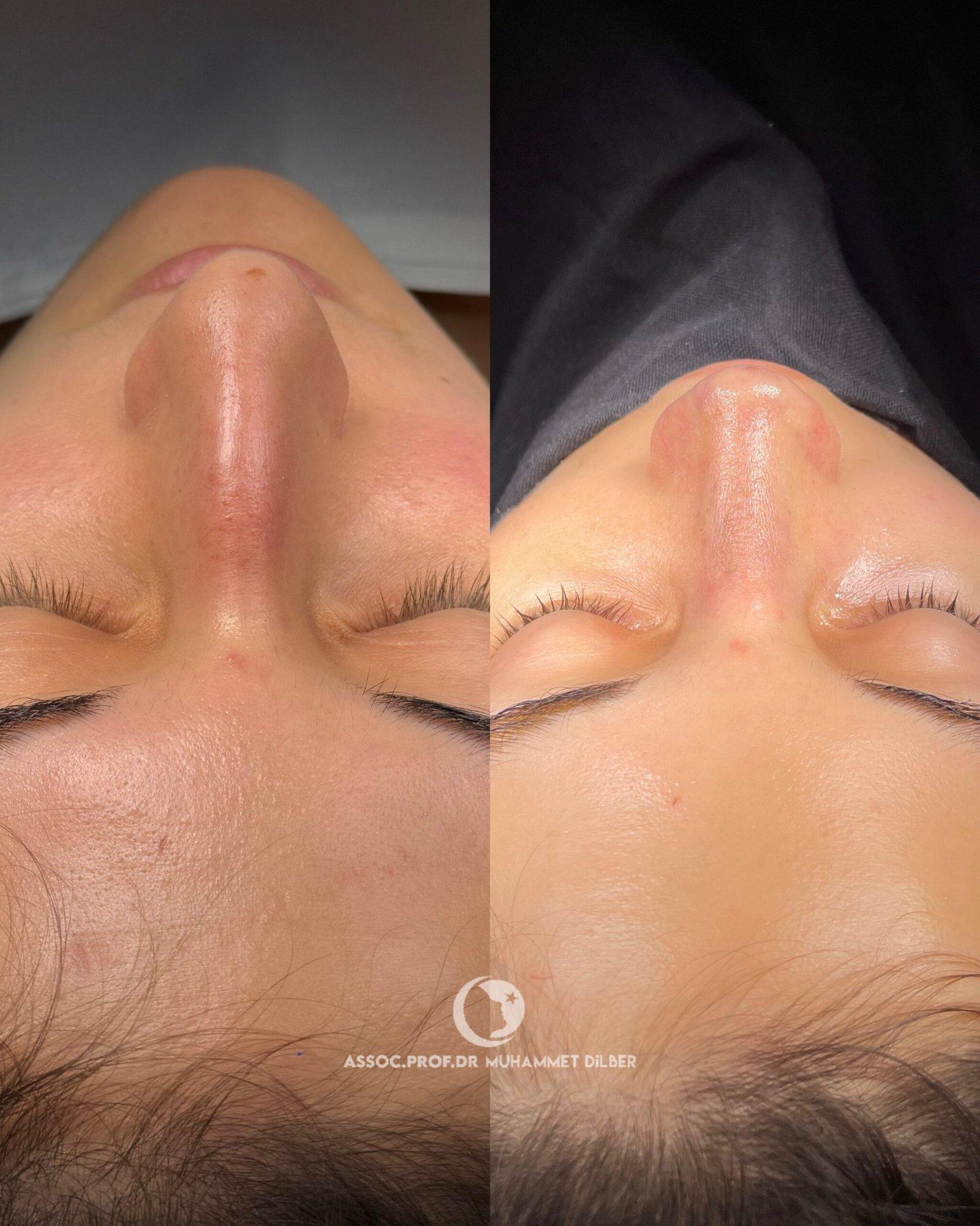 big humpy nose surgery turkey