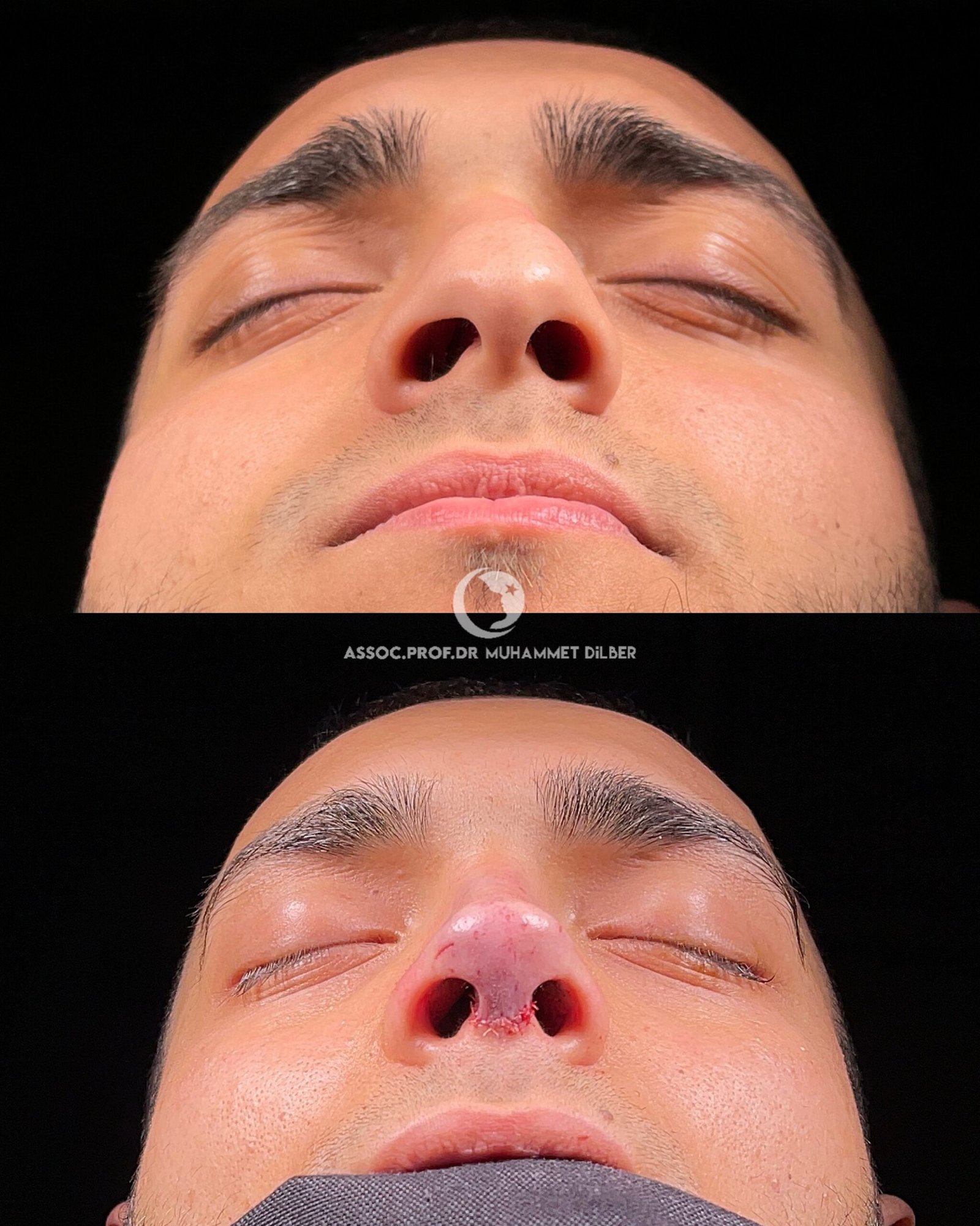 crooked nose & big nostrils