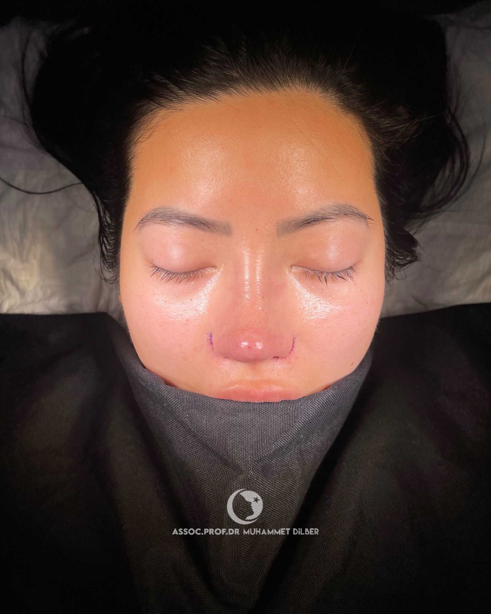 flat nose wings and crooked nose rhinoplasty