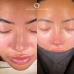 flat nose wings rhinoplasty - nose wing reduction before after