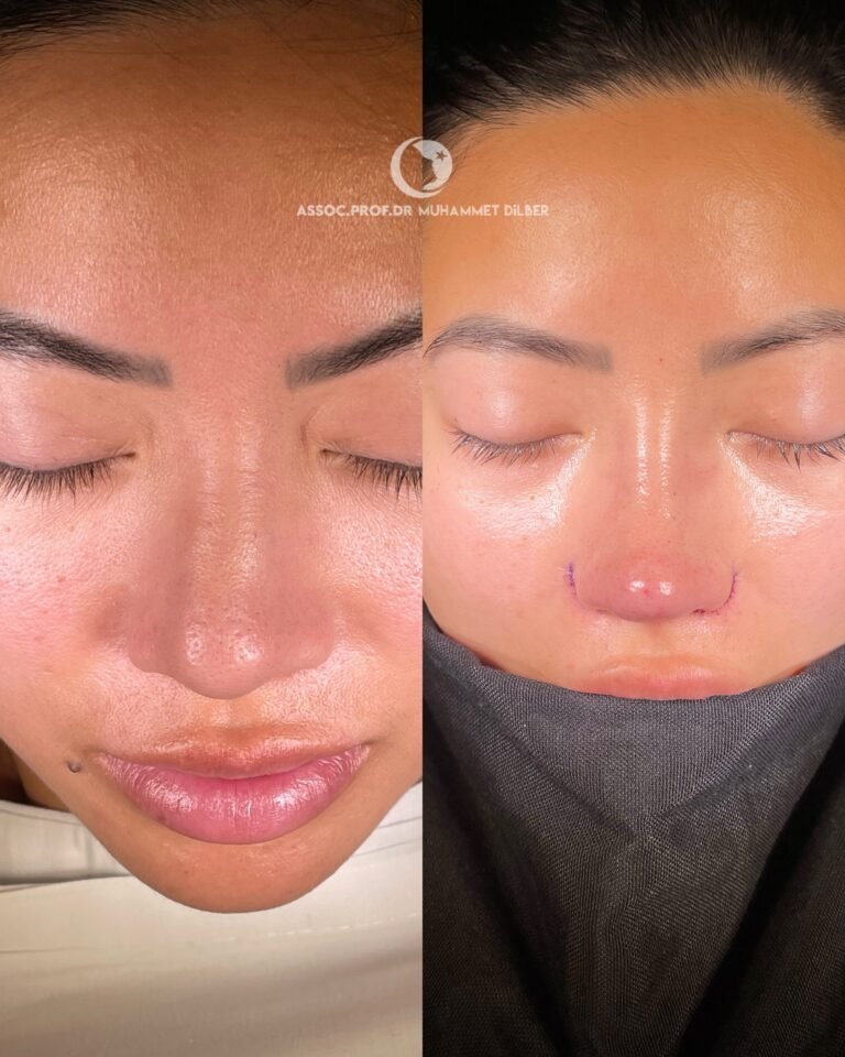 flat nose wings rhinoplasty - nose wing reduction before after