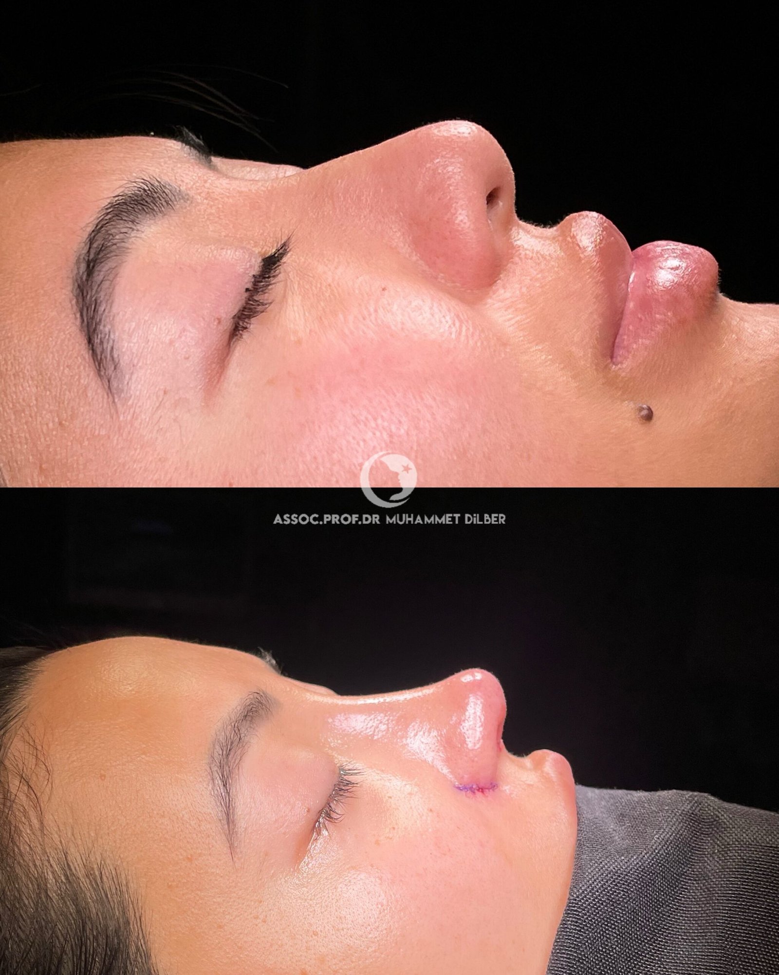 nose wing reduction - flat nose wings rhinoplasty before after