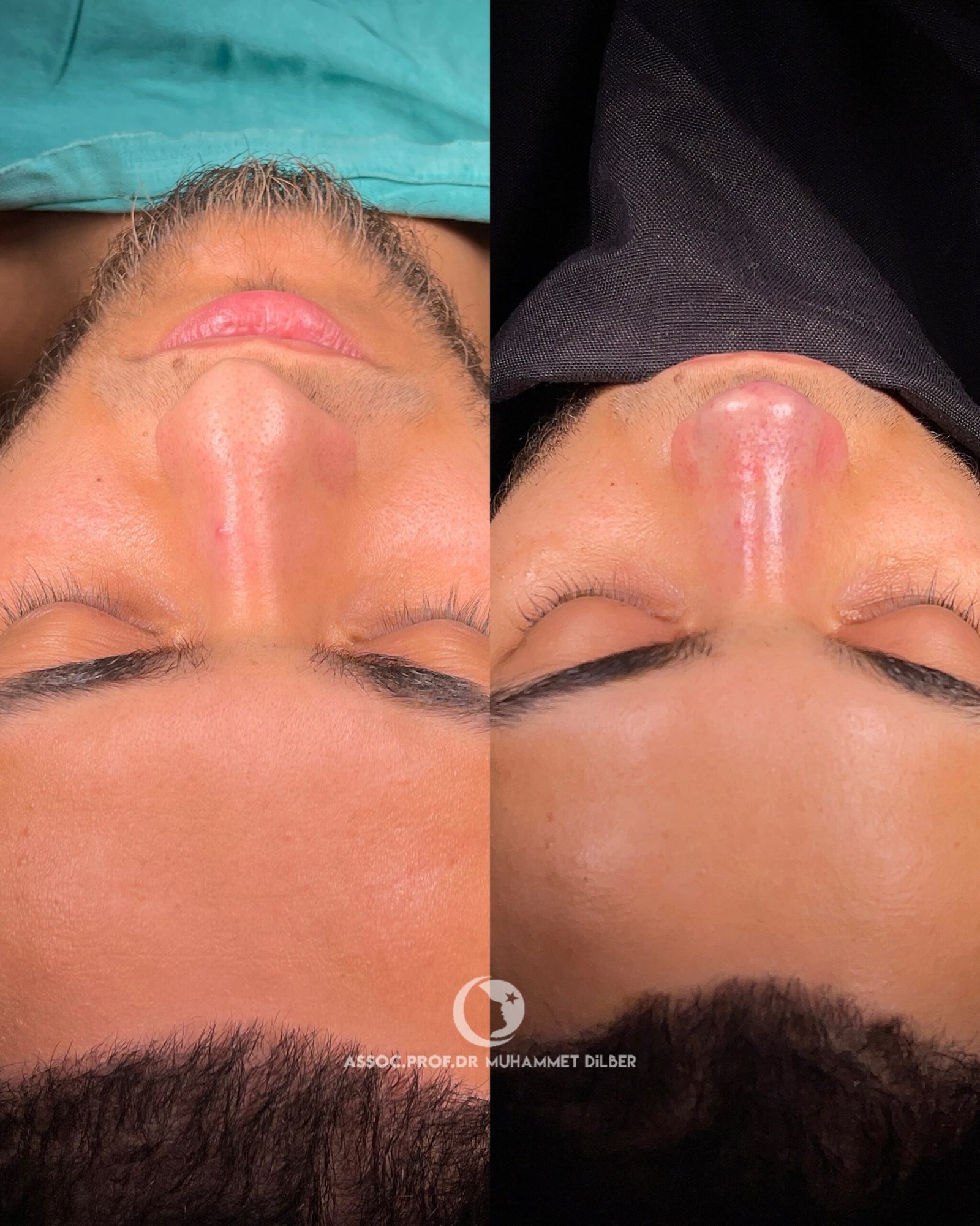 nose job congestion - breathing issues