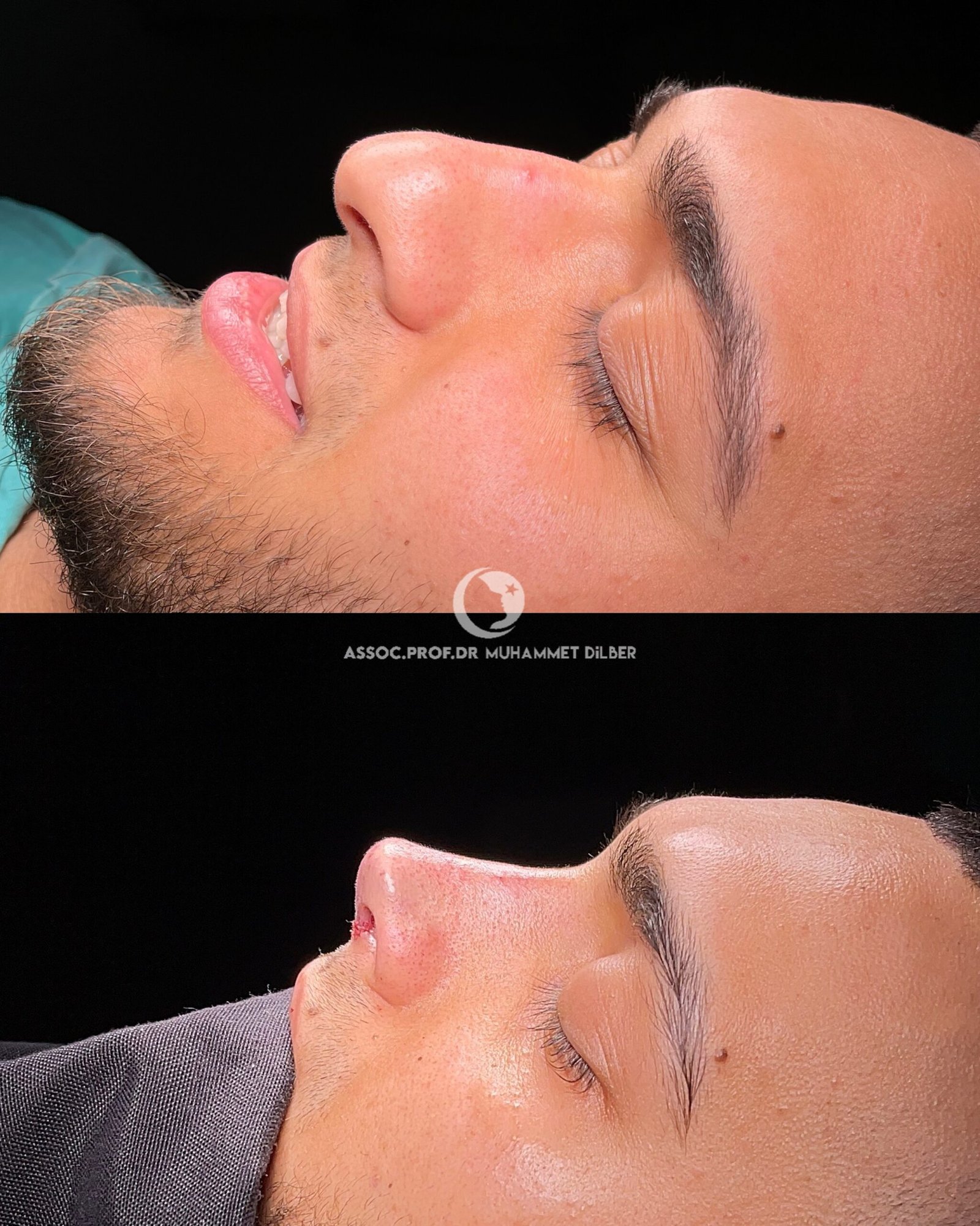 rhinoplasty fix breathing issues