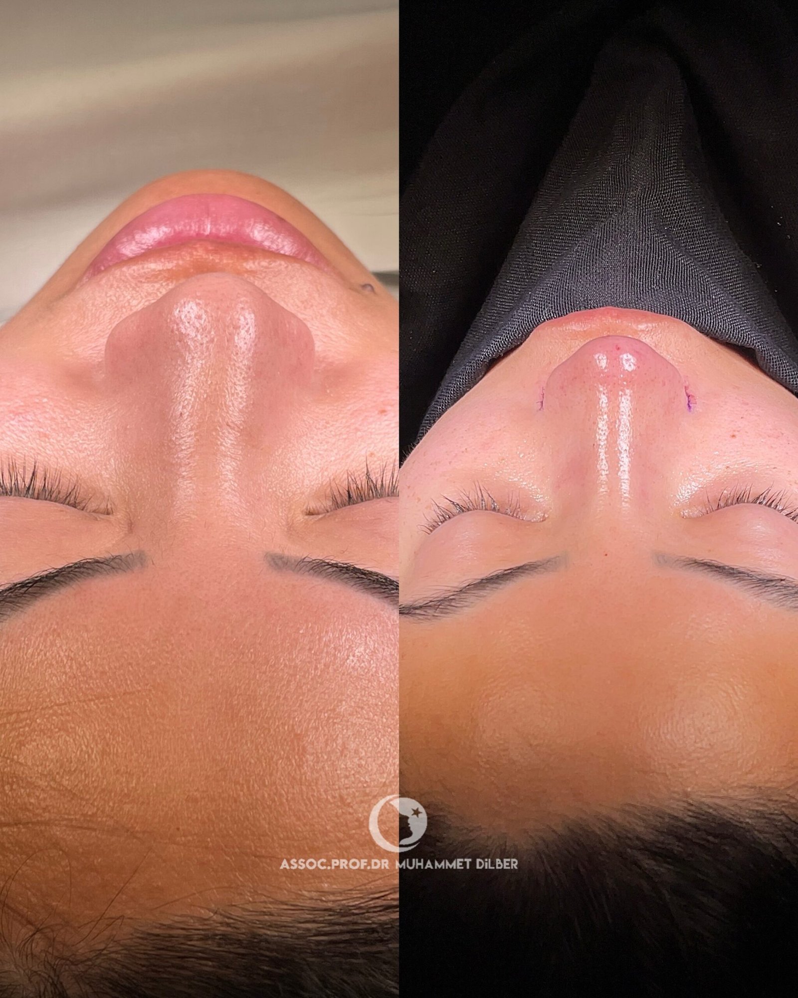 nose wing reduction surgery