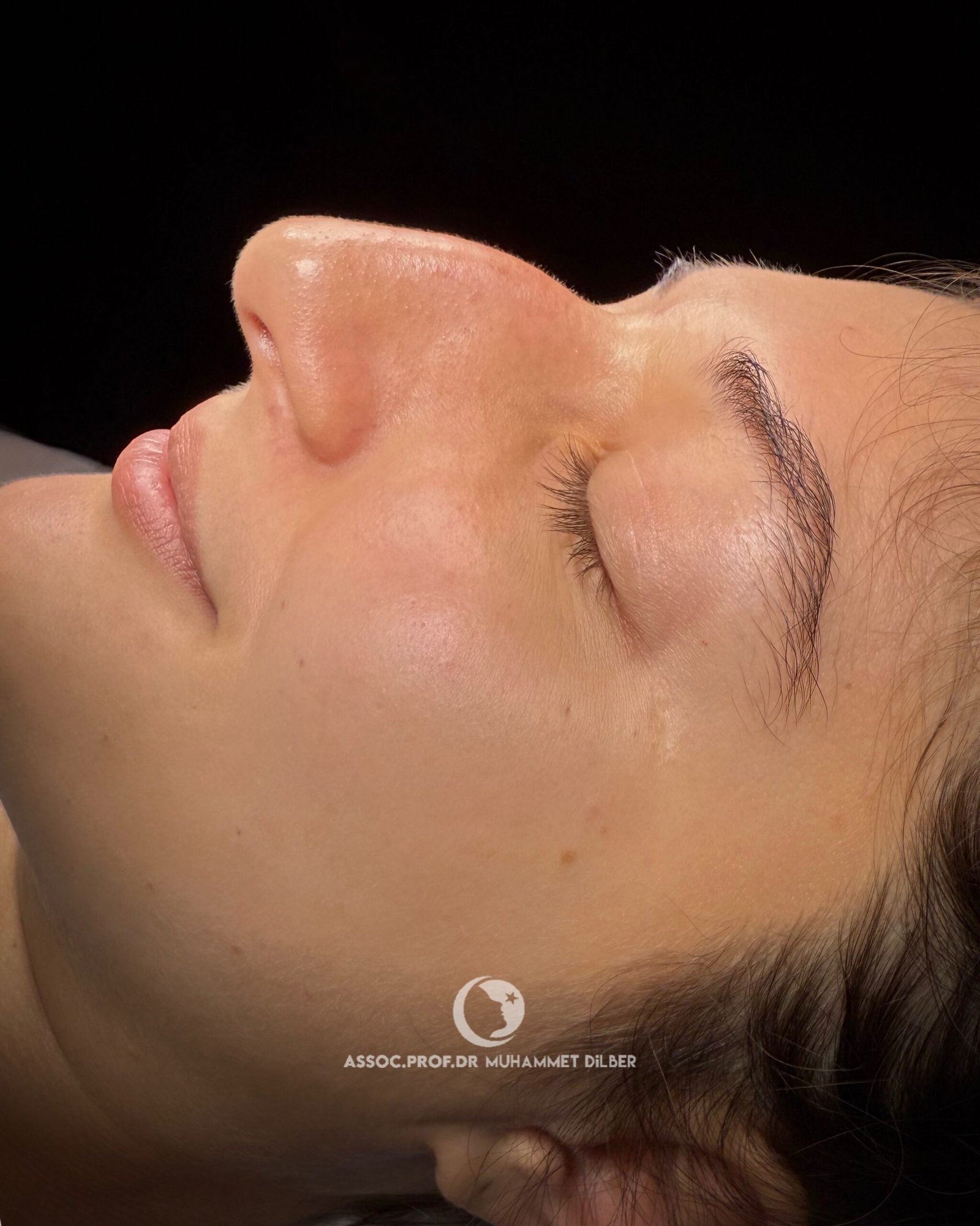 what is big humpy nose?