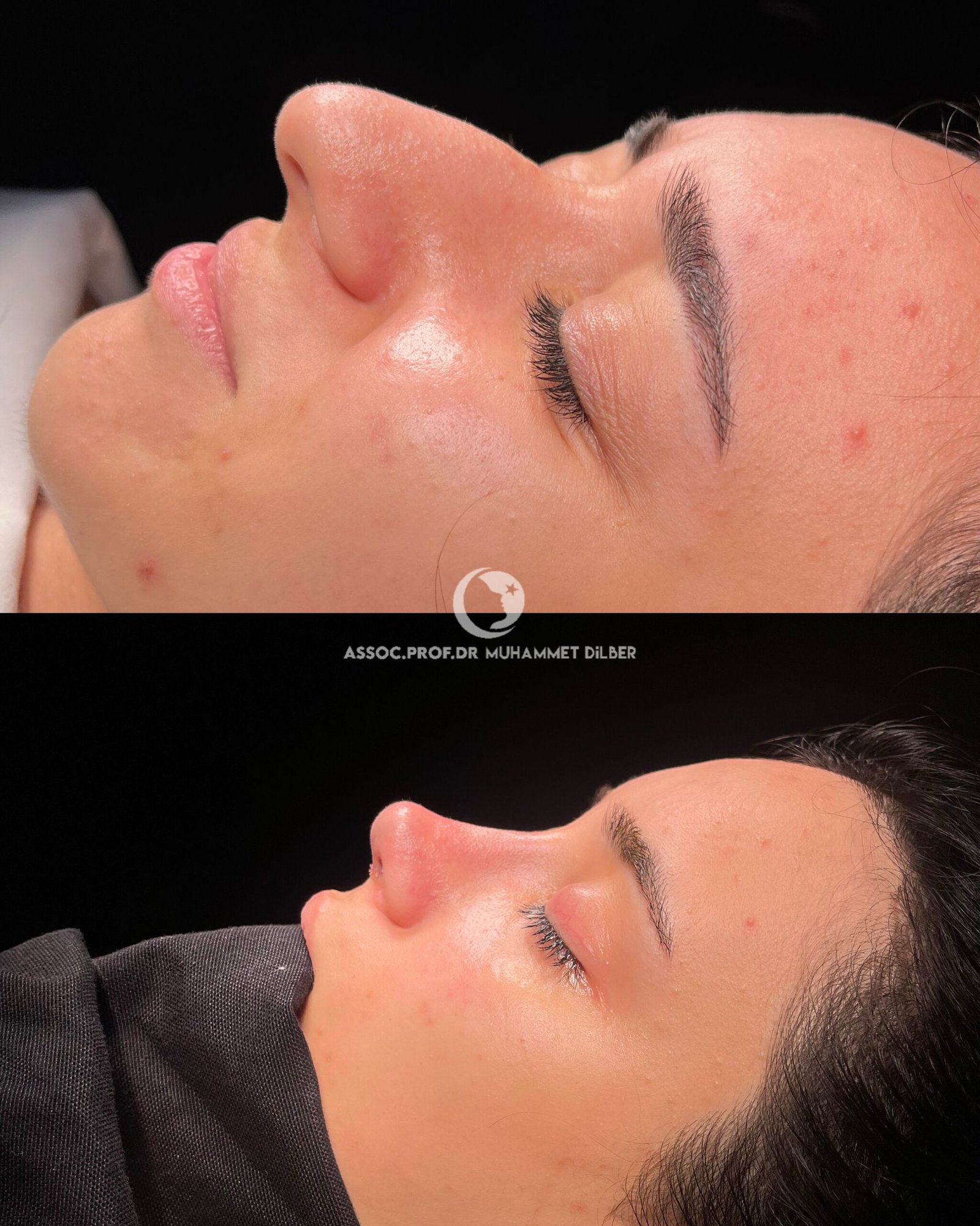 droopy tip before after