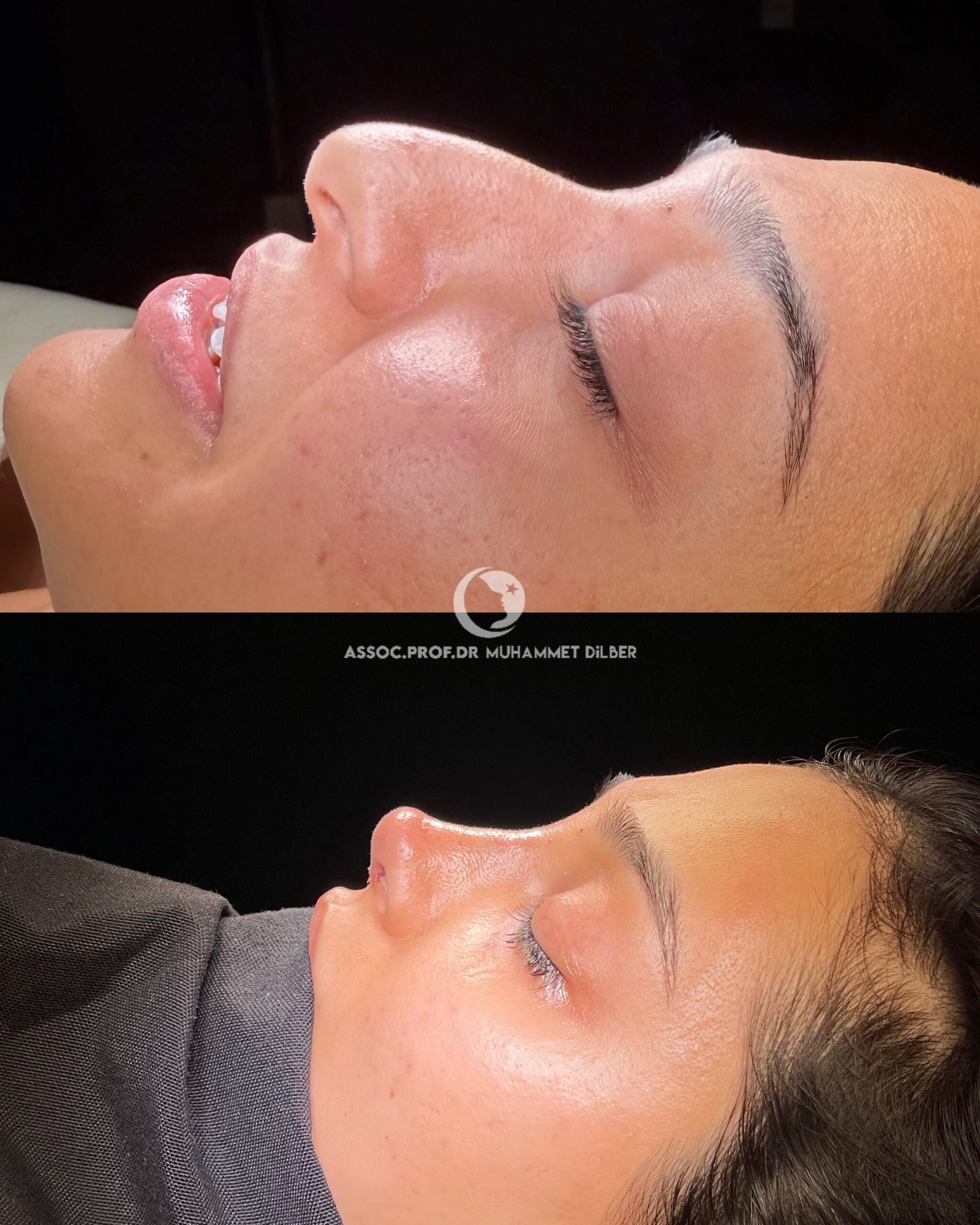 droopy nose rhinoplasty before after