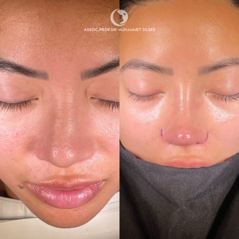 flat nose wings rhinoplasty - nose wing reduction before after