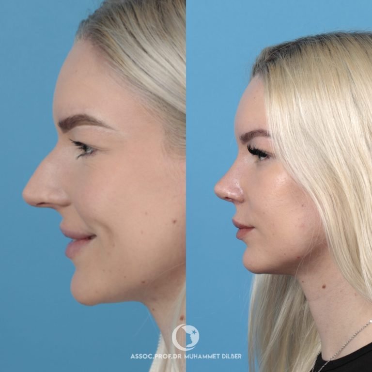 long nose bridge rhinoplasty before after